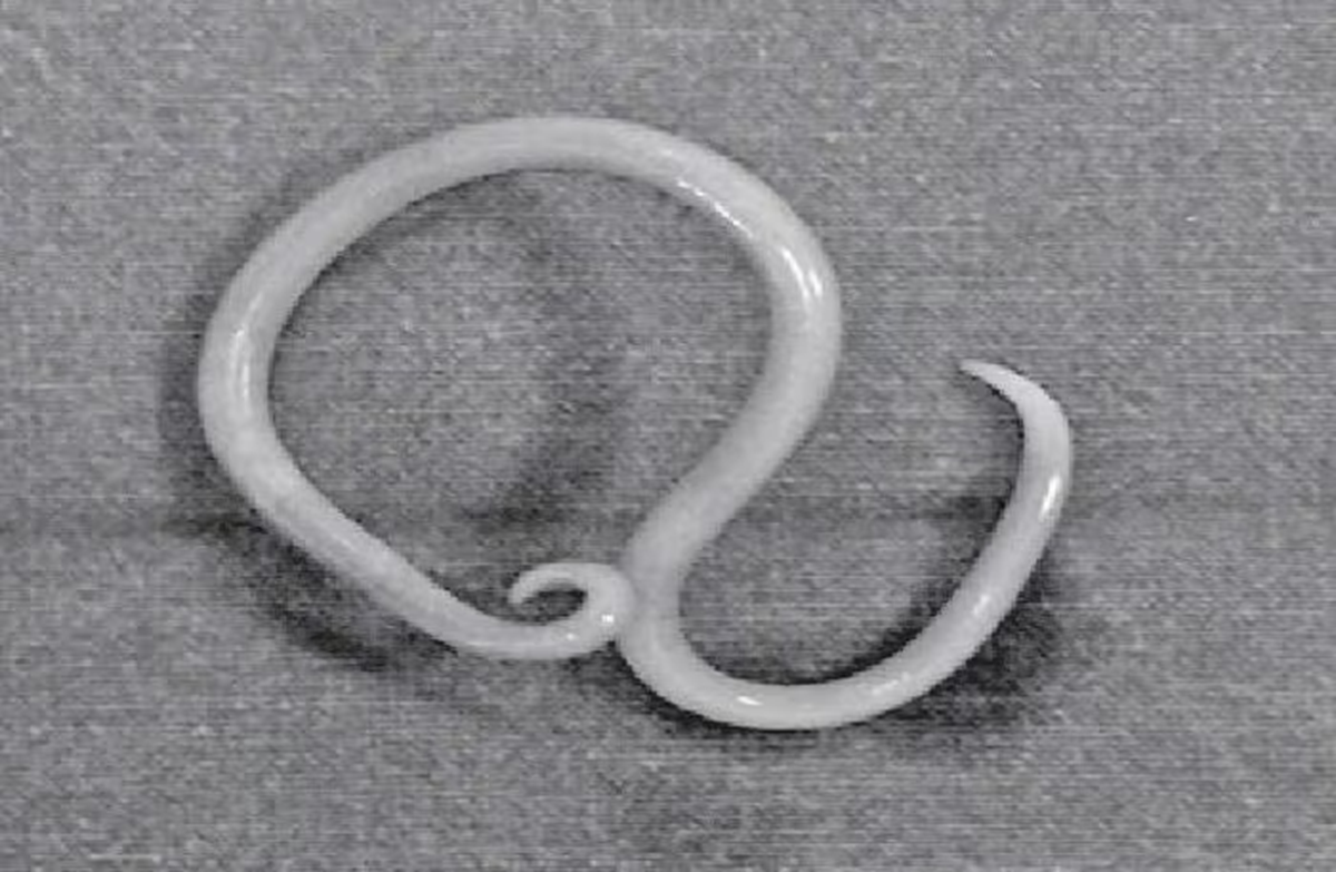 Thiếu niên 15 tuổi bị loét ruột nặng, bác sĩ phát hiện "bí mật" bên trong chứa đầy giun đũa - Ảnh 1.