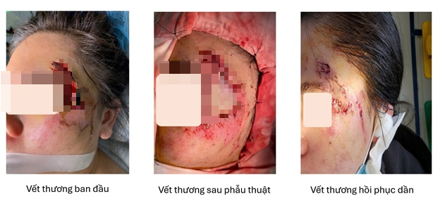 C&ocirc; g&aacute;i bị hoại tử v&ugrave;ng mặt do tai nạn giao th&ocirc;ng được gh&eacute;p da th&agrave;nh c&ocirc;ng- Ảnh 1.