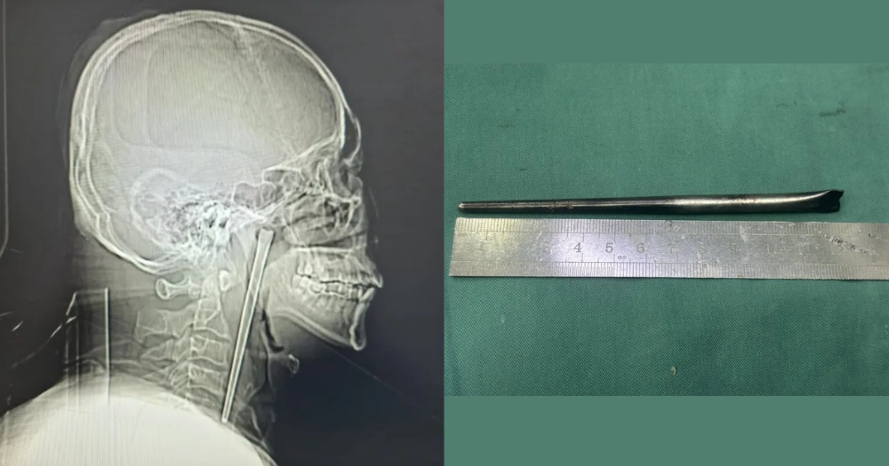 Người đàn ông đau họng dữ dội, bác sĩ lấy ra thứ đáng sợ bên trong - Ảnh 1.