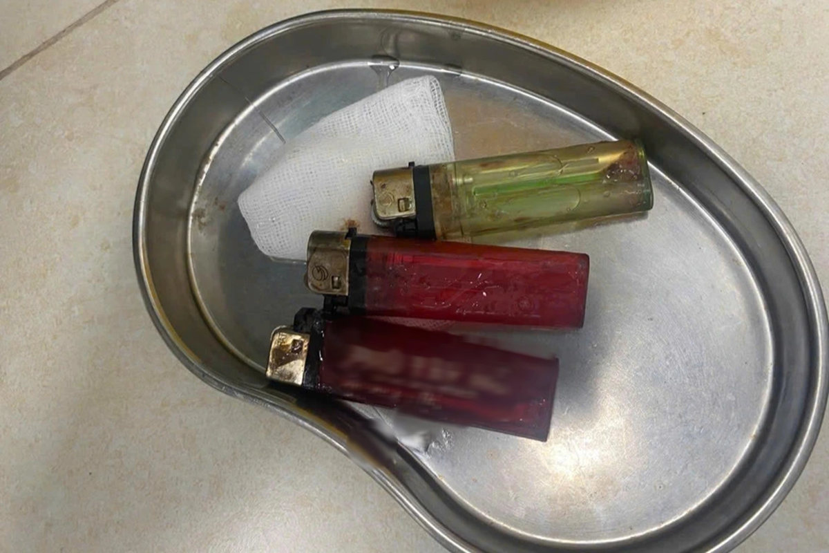 Bác sĩ sốc ngang khi gắp được 3 chiếc bật lửa từ bụng bệnh nhân - Ảnh 1.