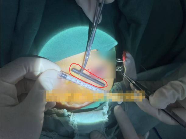 Bé trai đau mắt dữ dội, bác sĩ lấy ra thứ "đáng sợ" bên trong - Ảnh 2.