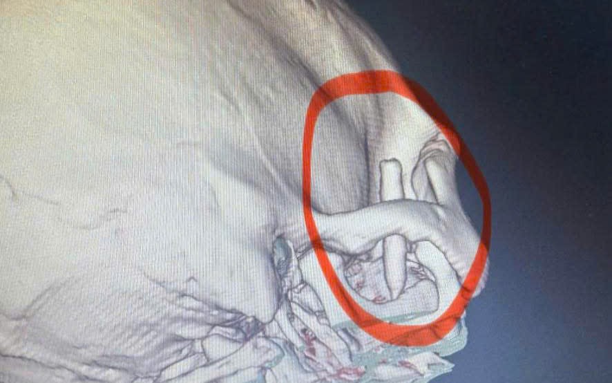 Bút Bi Mắc Kẹt 13 Năm Trong Thái Dương Được Phẫu Thuật Thành Công Tại Quảng Ninh
