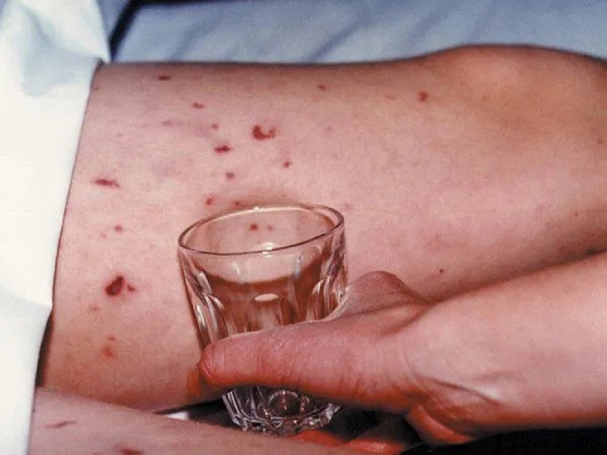 Bé gái 11 tuổi tử vong sau 9 giờ tím tái phát bệnh- Ảnh 1.