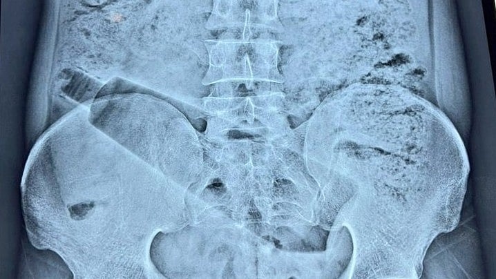 Người đàn ông đau bụng 36 tiếng, bác sĩ phát hiện 