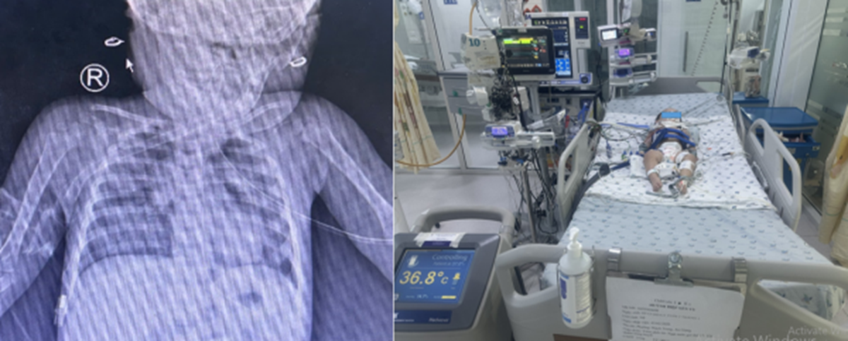 Bé gái hơn 1 tuổi nguy kịch vì phút lơ là của người lớn, bác sĩ cảnh báo thói quen 