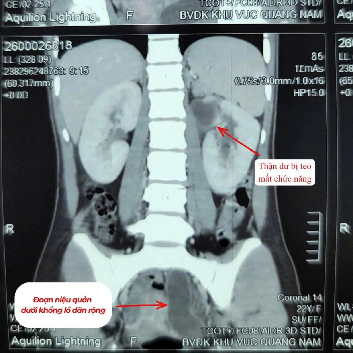 Kỳ lạ cô gái 22 tuổi có 3 quả thận - Ảnh 1.