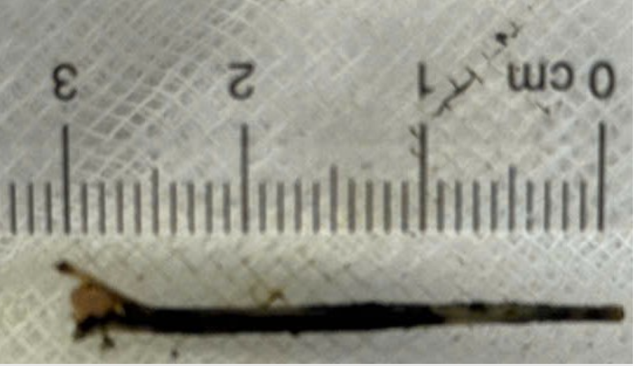 Đau bụng dữ dội nhiều ngày, người đàn ông suýt trả giá đắt khi bác sĩ phát hiện ra bí mật đáng sợ bên trong - Ảnh 2.