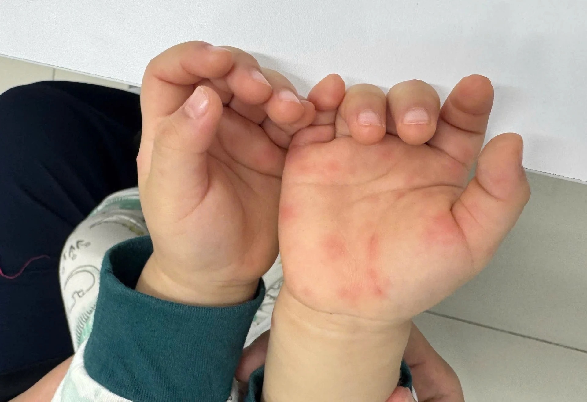 Hơn 25.000 ca mắc tay chân miệng: Cảnh báo nguồn lây phụ huynh hay bỏ quên- Ảnh 2.