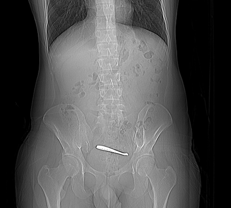 Người đàn ông đau bụng suốt 1 tuần, bác sĩ kiểm tra thì sốc nặng - Ảnh 1.