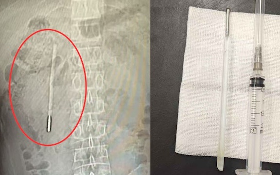 Chiếc nhiệt kế thủy ngân nằm trong bụng người đàn ông suốt 20 năm được lấy ra thành công