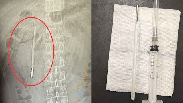 Đau bụng đi kh&aacute;m, người đ&agrave;n &ocirc;ng sốc nặng khi thấy thứ b&ecirc;n trong - Ảnh 1.