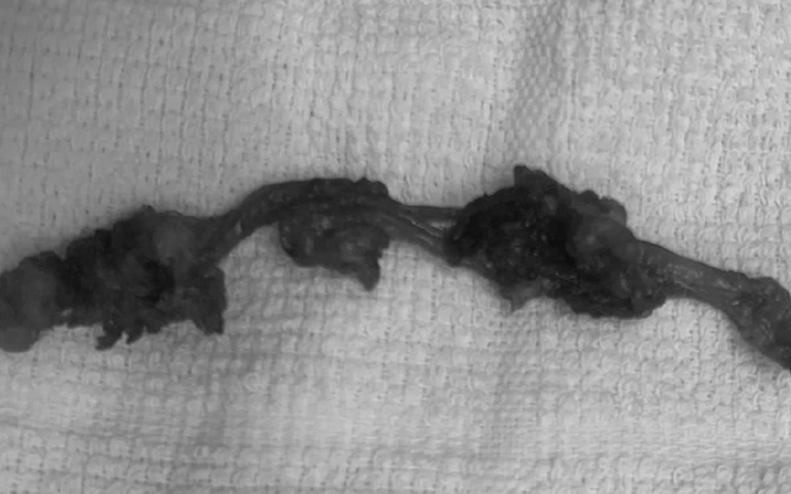 Đang chơi ở nhà, bé gần 2 tuổi nuốt phải thứ "đáng sợ" - Ảnh 2.