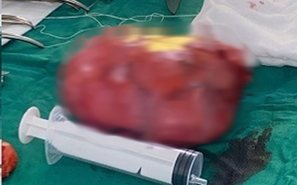 Bé 14 tuổi ho khan kéo dài, gia đình sốc khi bác sĩ lấy ra dị vật bên trong cơ thể- Ảnh 2.