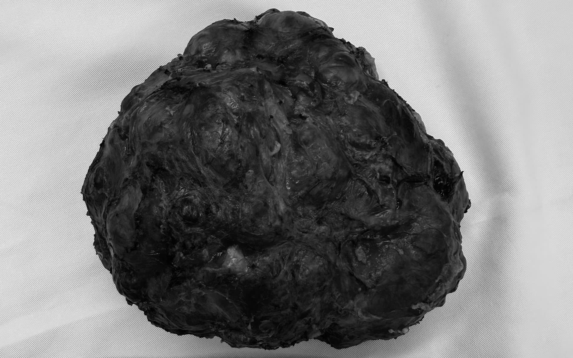 Nam thanh ni&ecirc;n 29 tuổi đau bụng, b&aacute;c sĩ lấy ra thứ "đ&aacute;ng sợ" trong cơ thể - Ảnh 2.