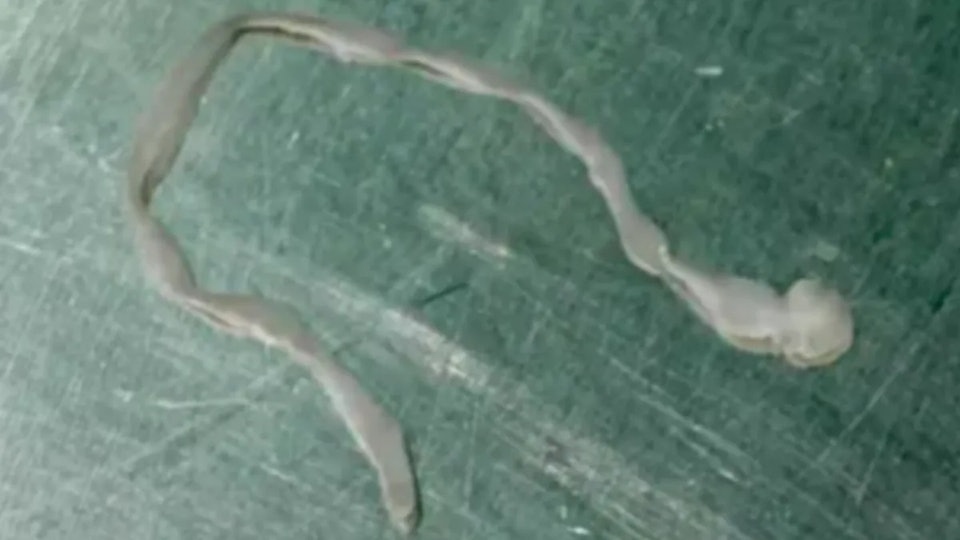 Người phụ nữ lên cơn co giật, bác sĩ lấy ra thứ đáng sợ trong não - Ảnh 1.