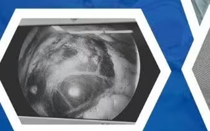 Thai Ngoài Tử Cung Hiếm Gặp Nằm Sát Mạch Máu Lớn, Bác Sĩ Cân Não Cứu Bệnh Nhân