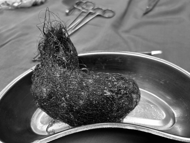 Phẫu thuật lấy b&uacute;i t&oacute;c "khủng" trong dạ d&agrave;y bệnh nhi 7 tuổi - Ảnh 1.