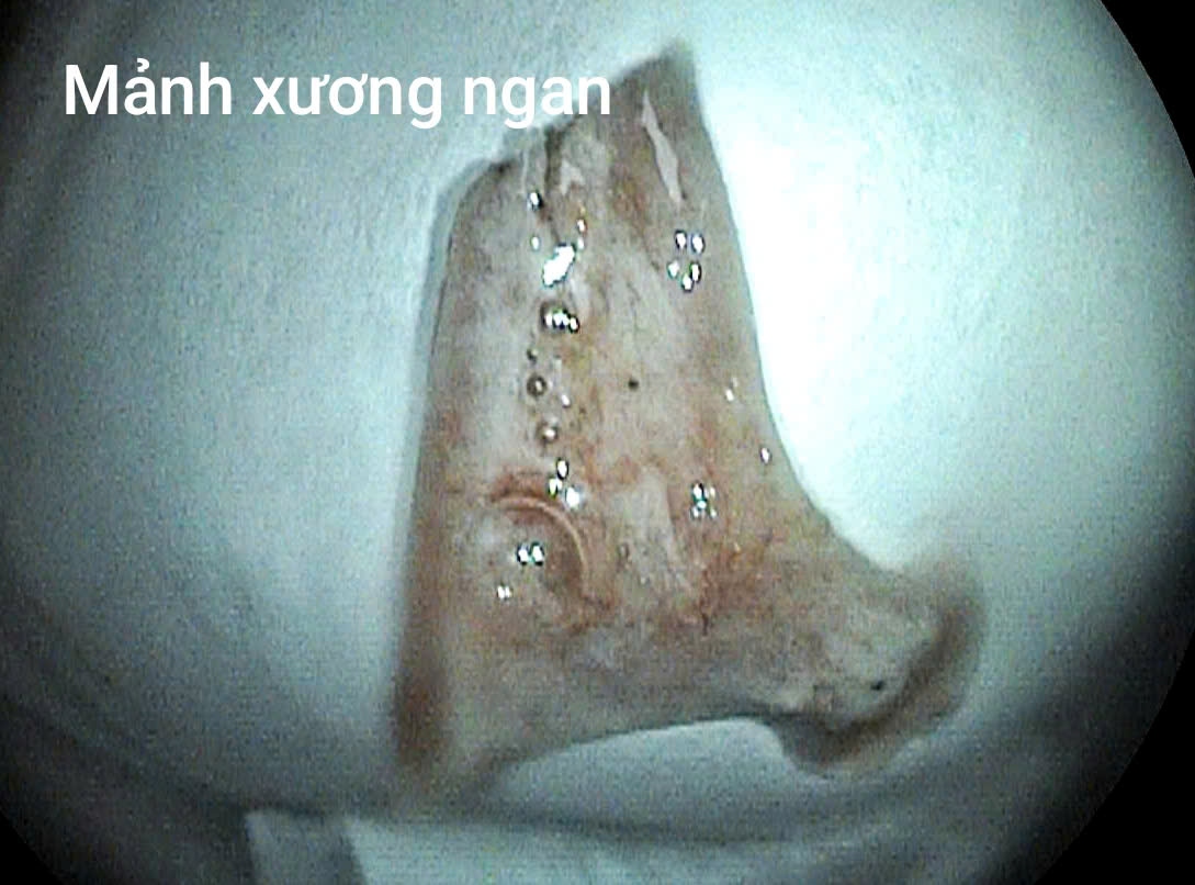 Người đàn ông nhập viện cấp cứu sau khi ăn món ngan luộc - Ảnh 2.