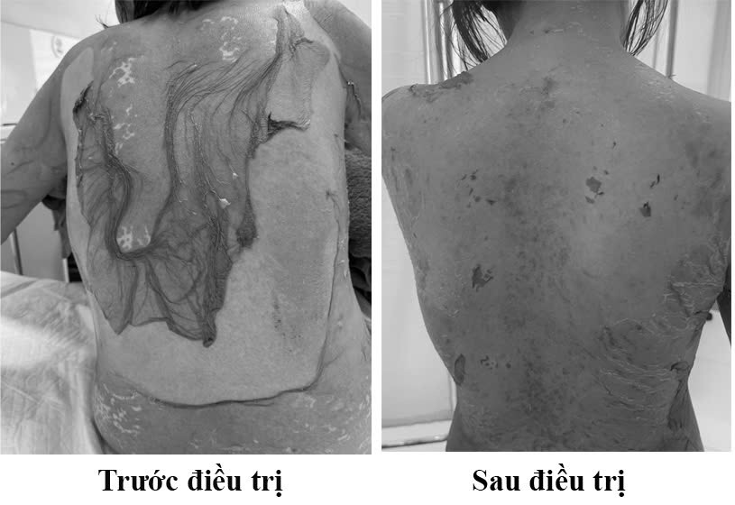 Người phụ nữ 35 tuổi da bị tróc da như 