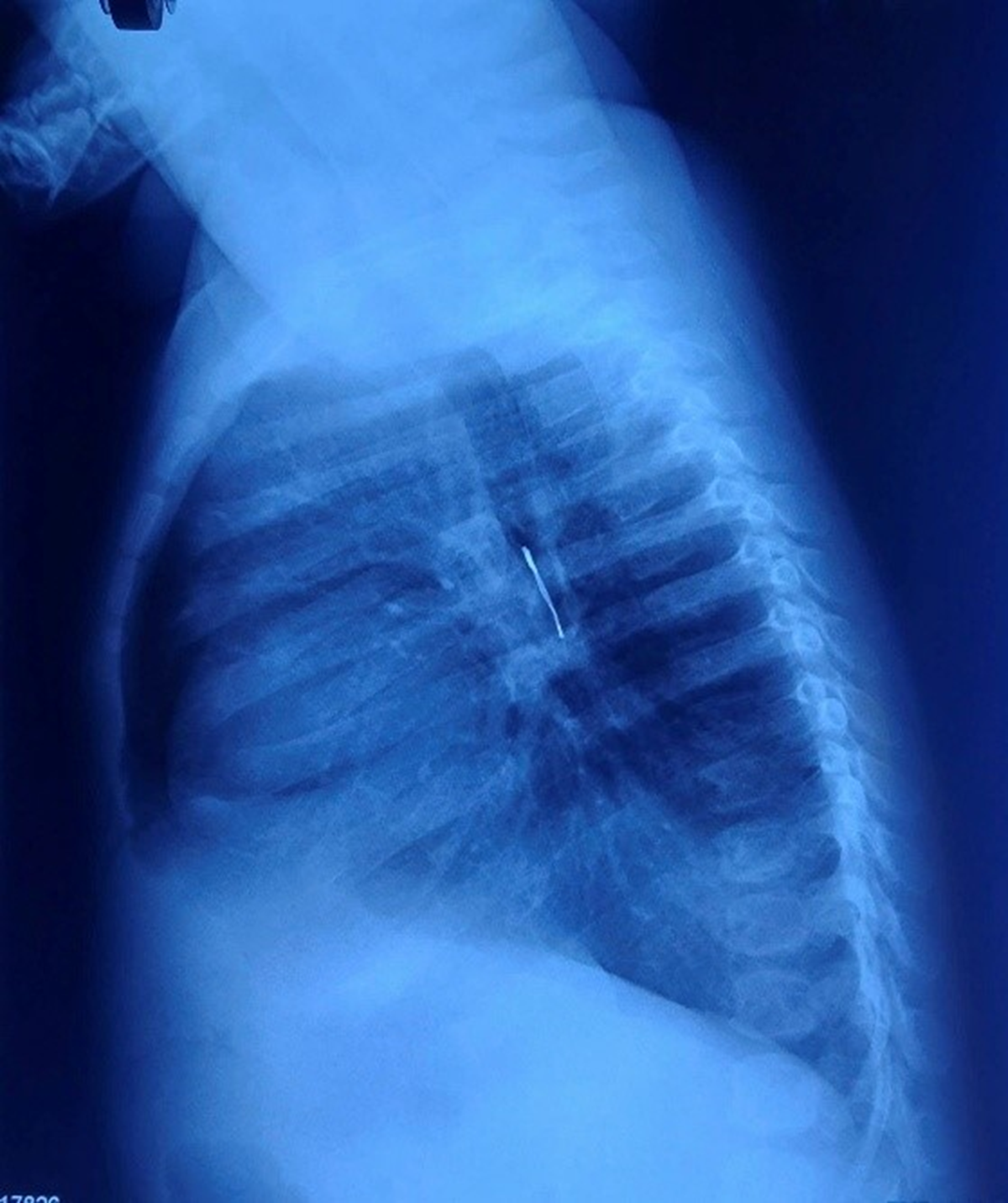 Bé 9 tháng tuổi ho nhiều ngày, bố mẹ 