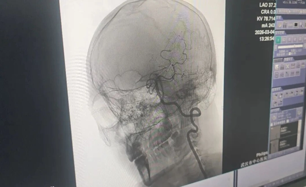 Người đàn 33 tuổi đột quỵ nguy kịch do đi mát xa theo kiểu