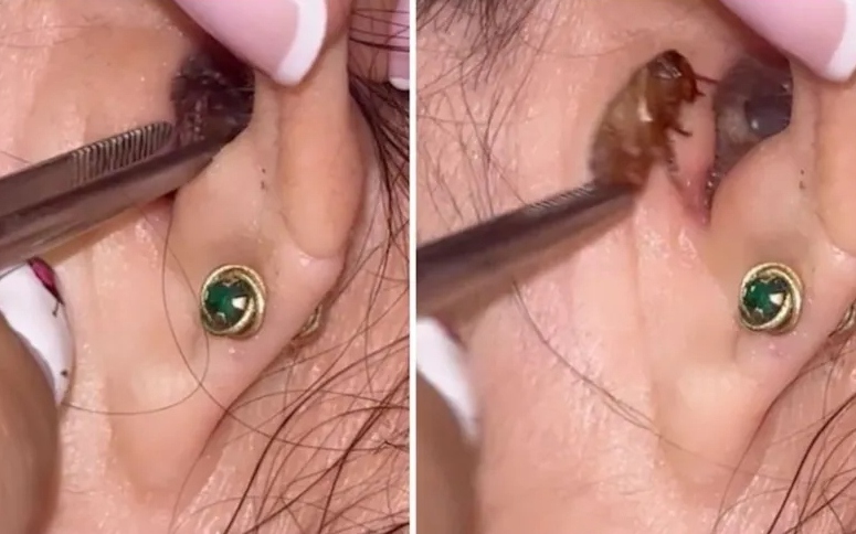 Gián Sống Trong Tai Bệnh Nhân: Clip Kinh Hoàng Lan Truyền Trên TikTok