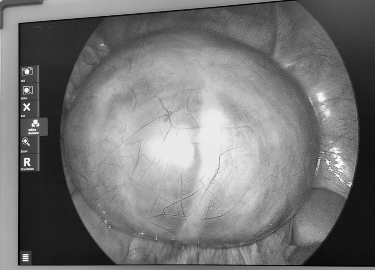 Đau bụng nhưng chủ quan, người phụ nữ sốc khi bác sĩ gắp ra thứ 
