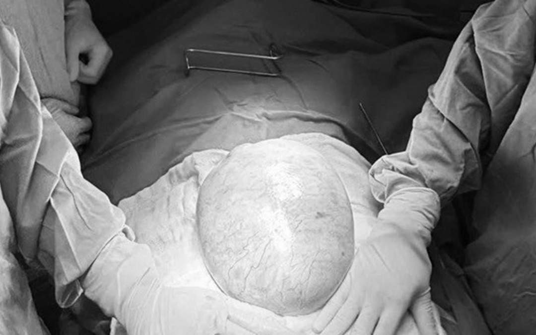 Người phụ nữ 58 tuổi "sốc" khi hắt hơi ra hàng loạt giòi sống trong mũi - Ảnh 2.