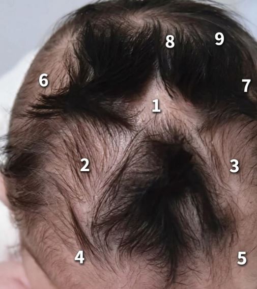 B&eacute; trai g&acirc;y "sốt mạng" v&igrave; c&oacute; tới 9 xo&aacute;y t&oacute;c v&ocirc; c&ugrave;ng hiếm gặp- Ảnh 1.