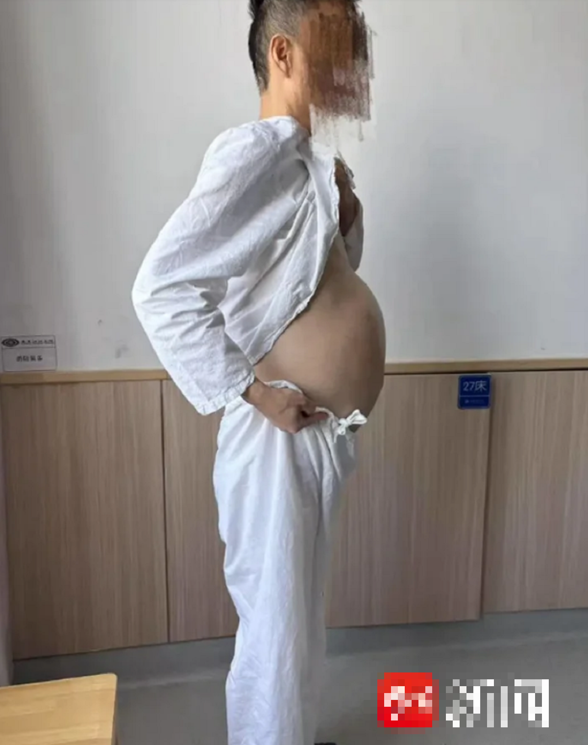 Người đàn ông 4 tháng không đi đại tiện, bụng phình to như 