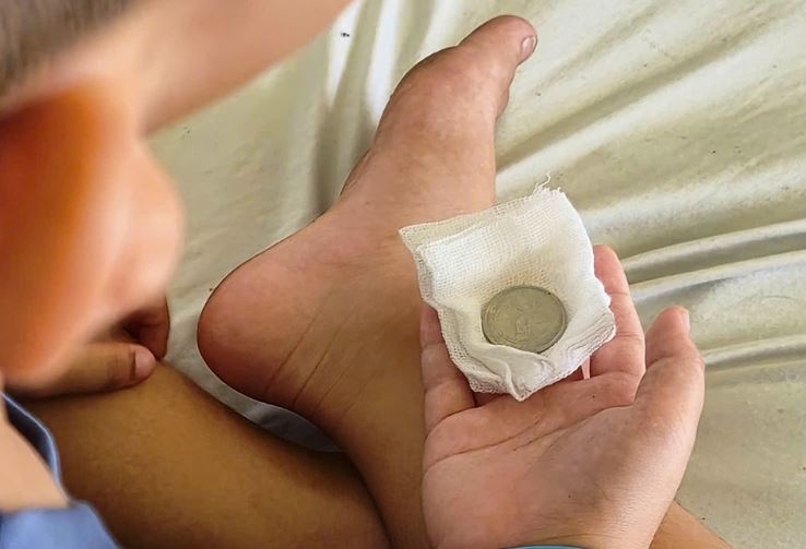 Bé trai 7 tuổi liên tục nôn ói, bác sĩ gắp ra thứ 