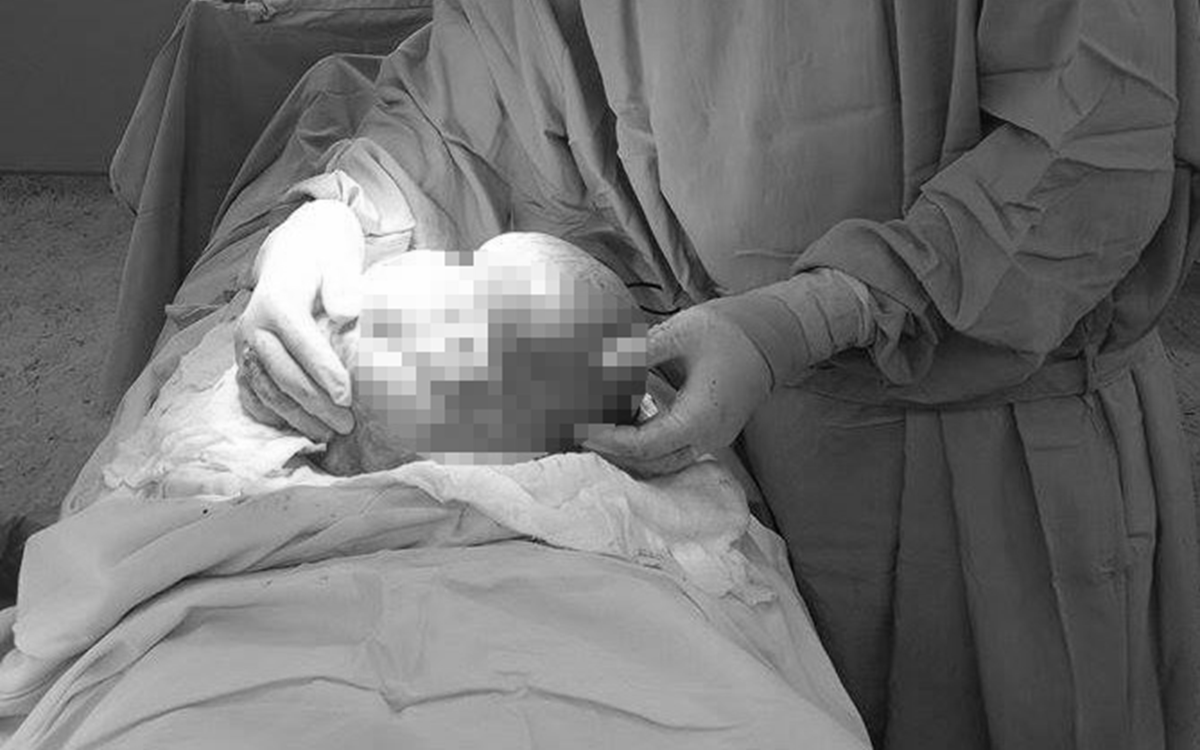 Bé 10 ngày tuổi bụng chướng căng, bác sĩ phát hiện thứ "đáng sợ" to như quả trứng ẩn bên trong - Ảnh 3.