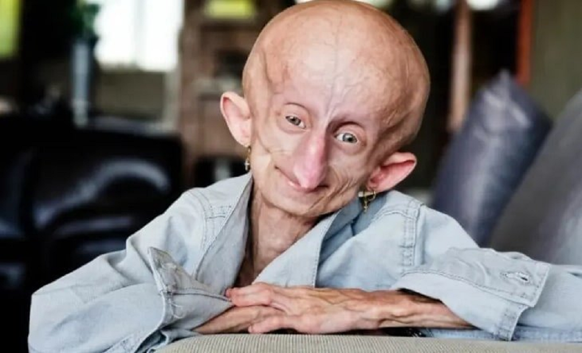 Bi kịch cô gái 19 tuổi với gương mặt như 90 tuổi: Số phận khiến nhiều người nghẹn ngào - Ảnh 1.