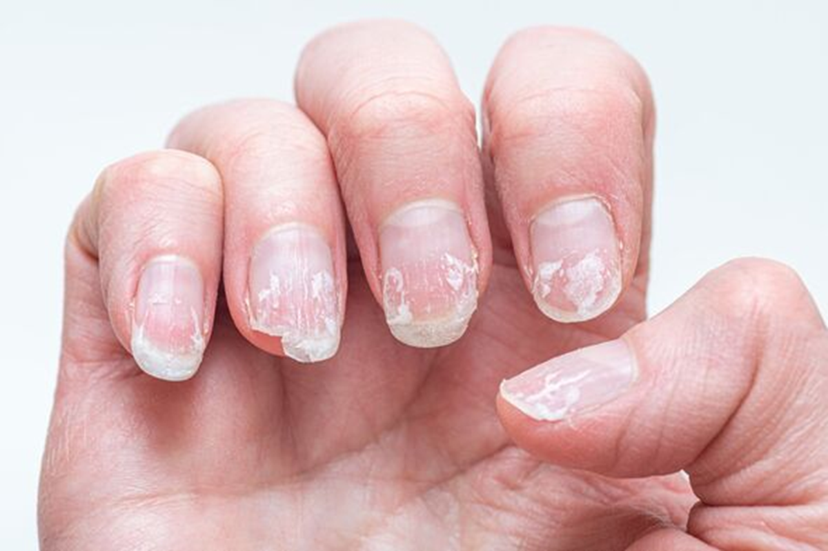 6 bất thường trên móng tay có thể đang “tố cáo” bệnh trong cơ thể bạn - Ảnh 1.