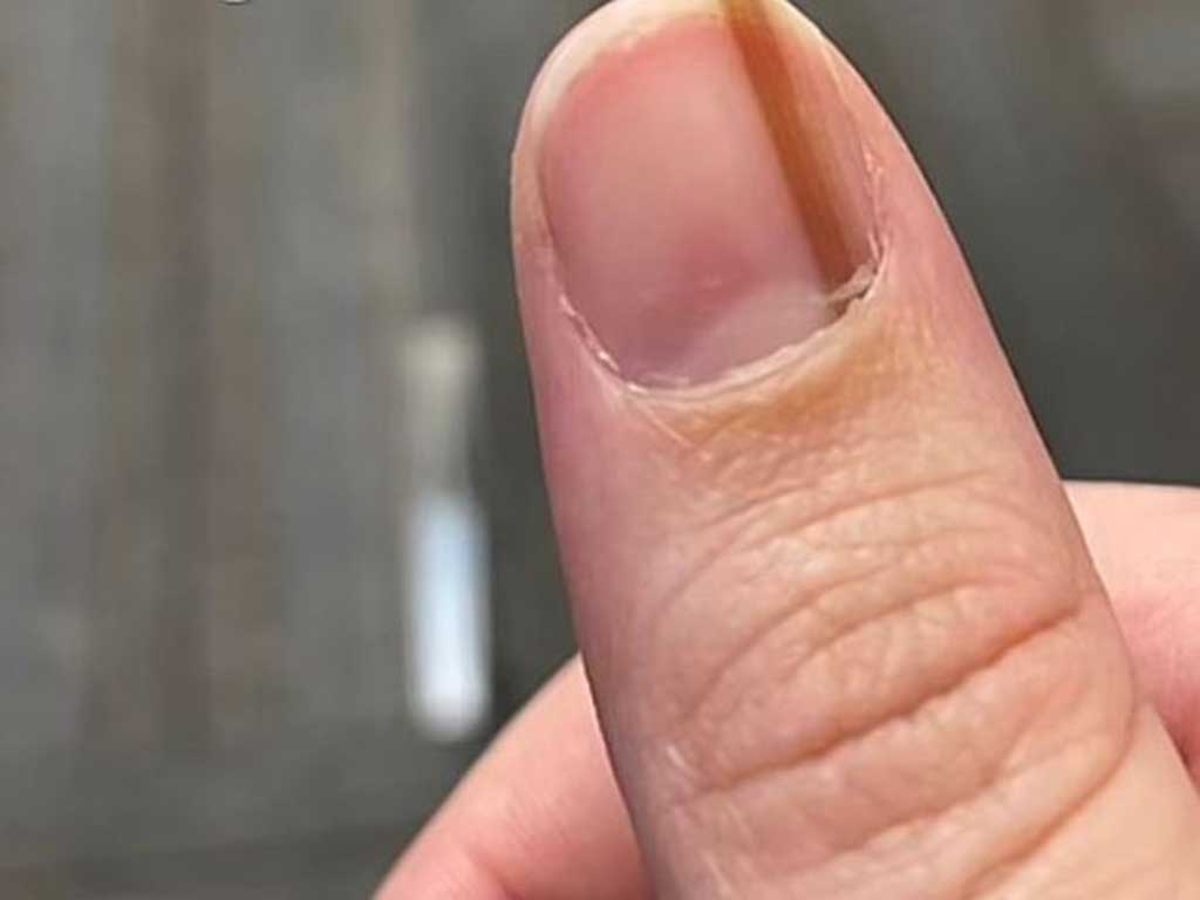 6 bất thường trên móng tay có thể đang “tố cáo” bệnh trong cơ thể bạn - Ảnh 2.