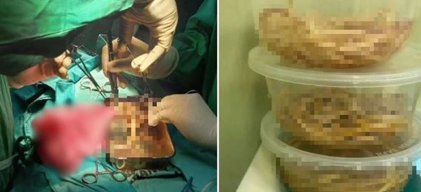 Bé trai 3 tuổi nôn ra giun, khi phẫu thuật bác sĩ phát hiện điều đáng sợ hơn- Ảnh 1. Bé trai 3 tuổi nôn ra giun, khi phẫu thuật bác sĩ phát hiện điều đáng sợ hơn- Ảnh 1.