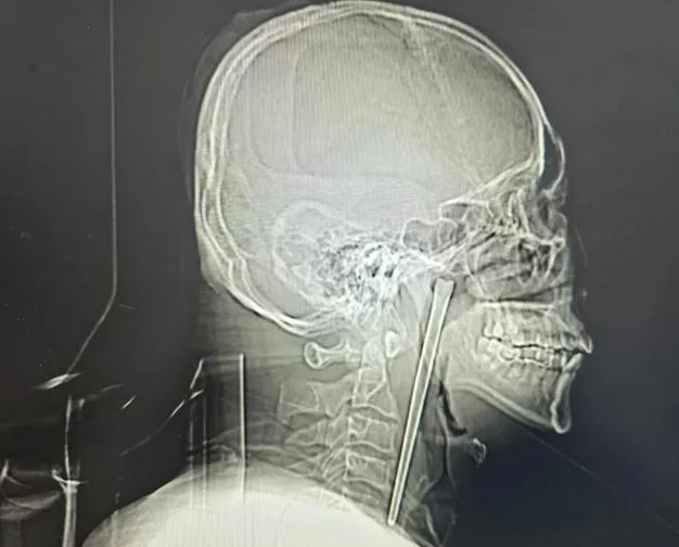 Đau nhói mắt trái, người đàn ông 50 tuổi sốc nặng khi bác sĩ gắp ra thứ 