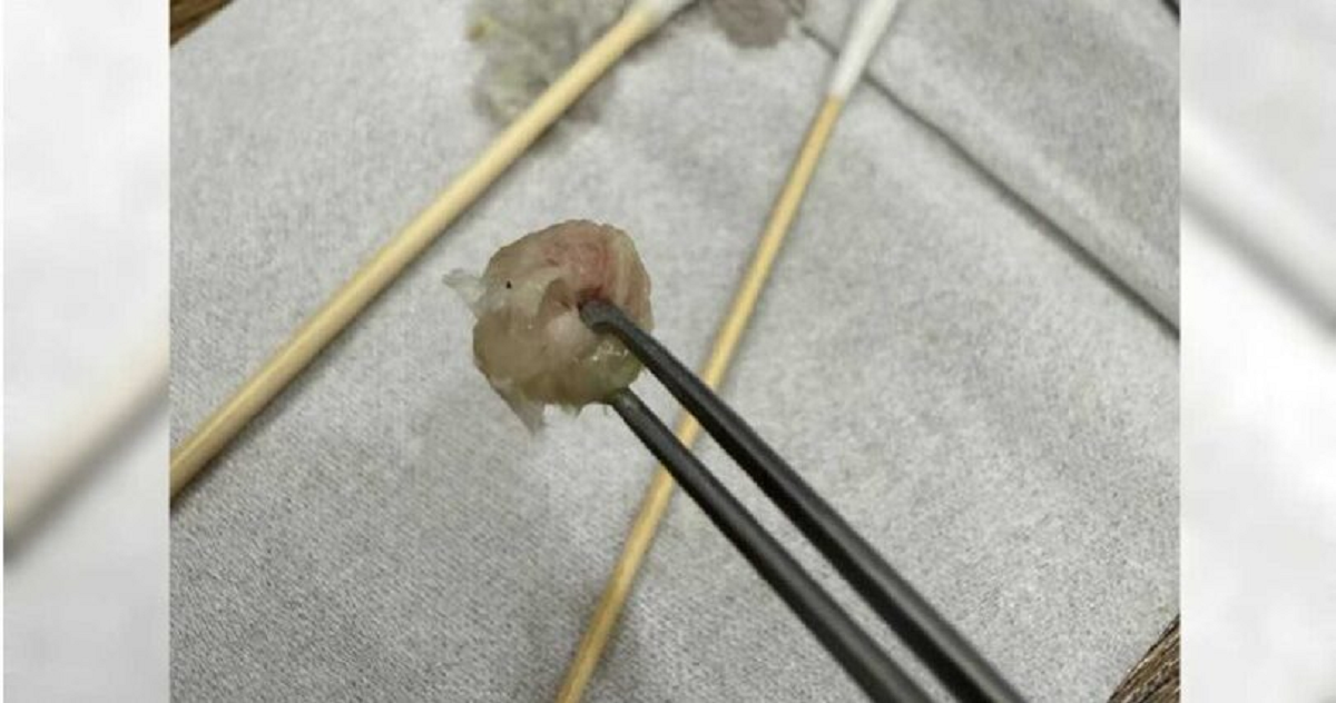 Bé gái 6 tuổi đau khổ vì nghẹt mũi, sự thật bên trong khiến bố mẹ