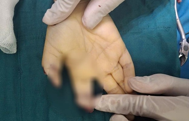 Chơi xe điện tự chế, b&eacute; trai 5 tuổi gặp tai nạn nghi&ecirc;m trọng - Ảnh 1.