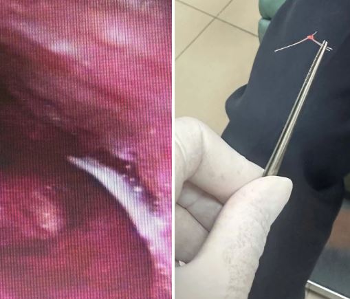 Đau họng sau khi ăn b&aacute;nh m&igrave;, người phụ nữ 47 tuổi sốc nặng khi b&aacute;c sĩ lấy ra thứ "đ&aacute;ng sợ" - Ảnh 2.