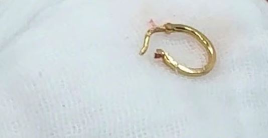 B&eacute; g&aacute;i 8 th&aacute;ng tuổi ho, quấy kh&oacute;c k&eacute;o d&agrave;i, b&aacute;c sĩ sốc nặng khi gắp ra thứ "đ&aacute;ng sợ" - Ảnh 2.