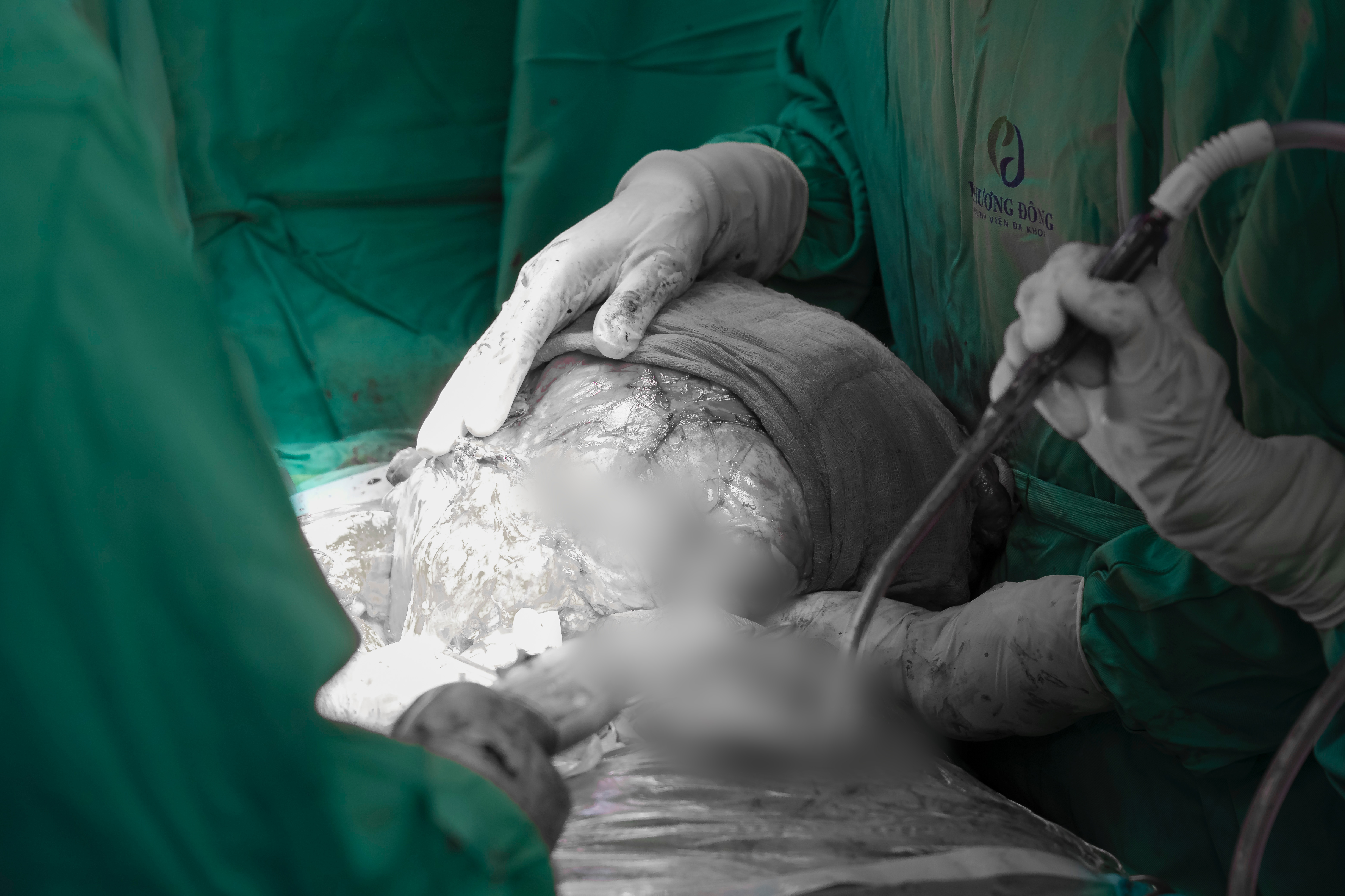 Người phụ nữ ở Hà Nội suy kiệt vì mang khối u khổng lồ 5kg- Ảnh 2.