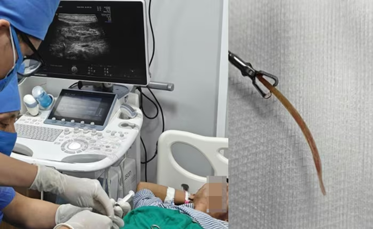 Đau bụng nhiều ngày tưởng nhẹ, đi khám người đàn ông 