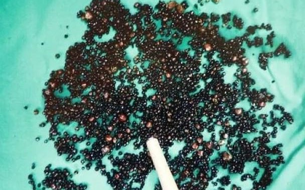 Đau bụng dữ dội, người phụ nữ 52 tuổi sốc nặng sau khi đi cấp cứu - Ảnh 3.