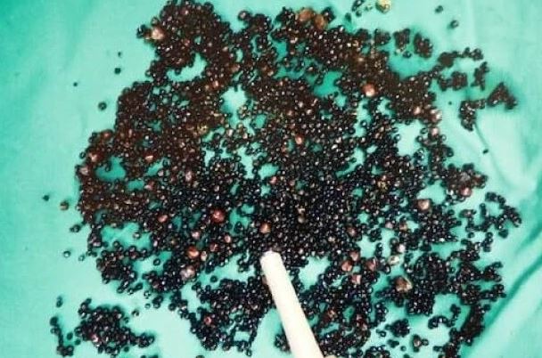 Đau bụng suốt nhiều tháng, người đàn ông 43 tuổi sốc nặng khi bác sĩ gắp ra thứ "đáng sợ" trong bụng - Ảnh 1.