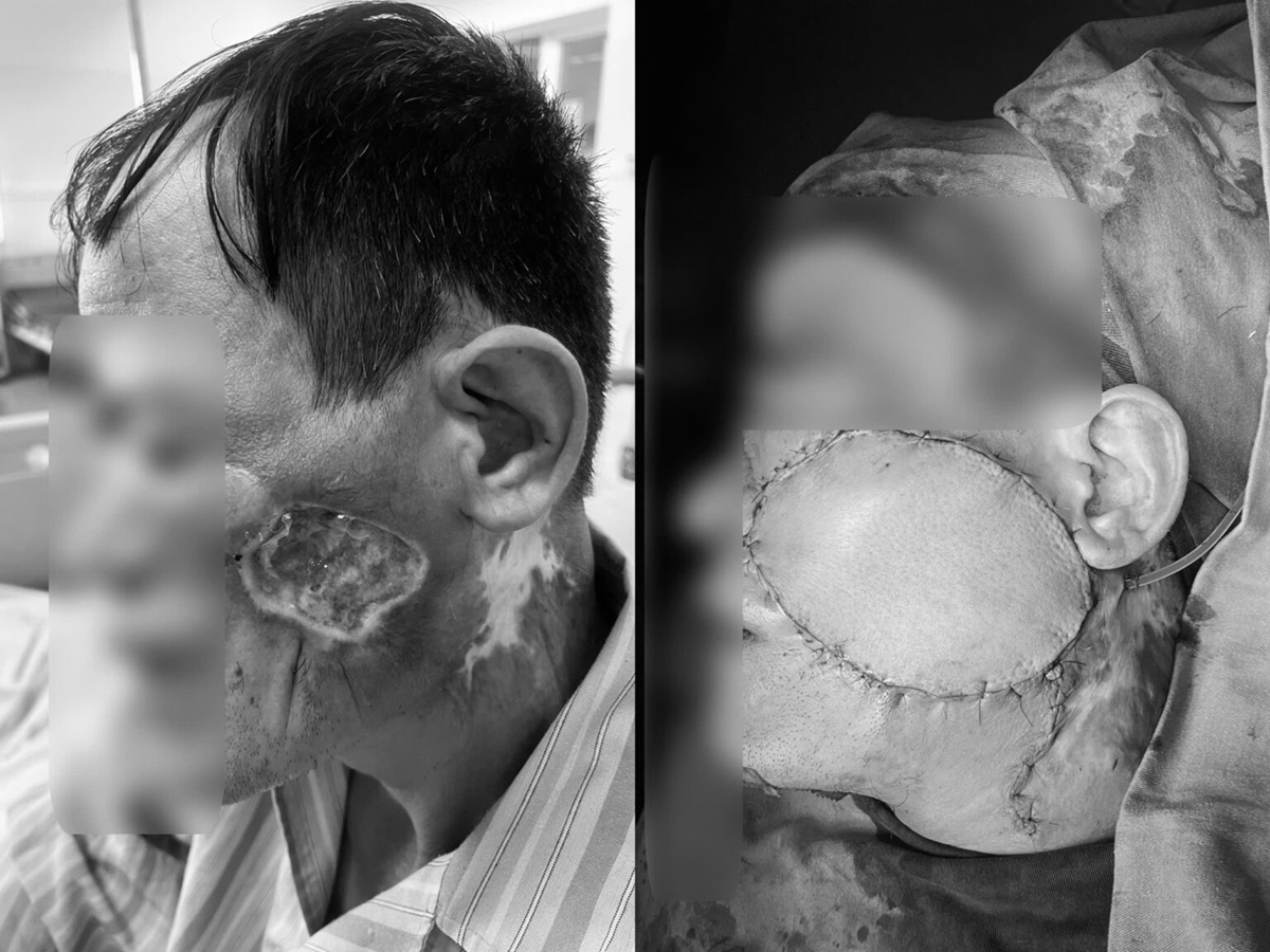 Người đàn ông suýt chết vì... một nốt ruồi - Ảnh 1.