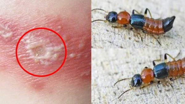 Những sai lầm phổ biến khi nhầm viêm da do kiến ba khoang với bệnh zona thần kinh - Ảnh 1.