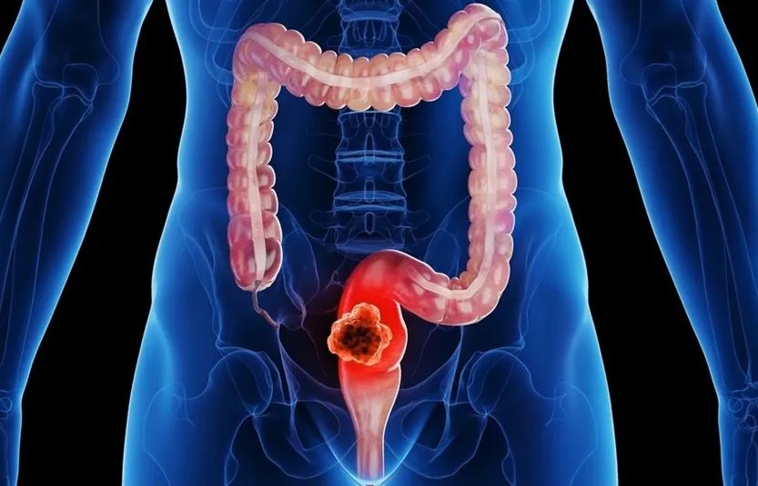 Người đàn ông 45 tuổi tử vong sau khi sụt cân, bác sĩ chỉ rõ 3 kiểu ăn sáng