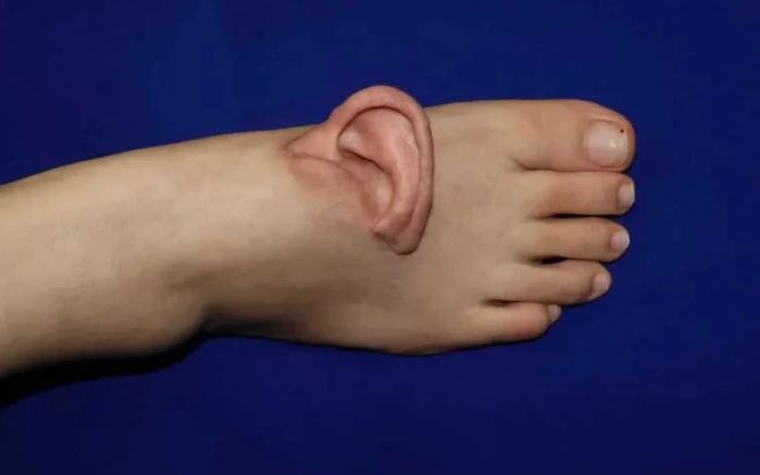 Người đàn ông mọc "sừng quỷ" dài 10 cm trên đầu và cái kết bất ngờ- Ảnh 2. Người đàn ông mọc "sừng quỷ" dài 10 cm trên đầu và cái kết bất ngờ- Ảnh 2.