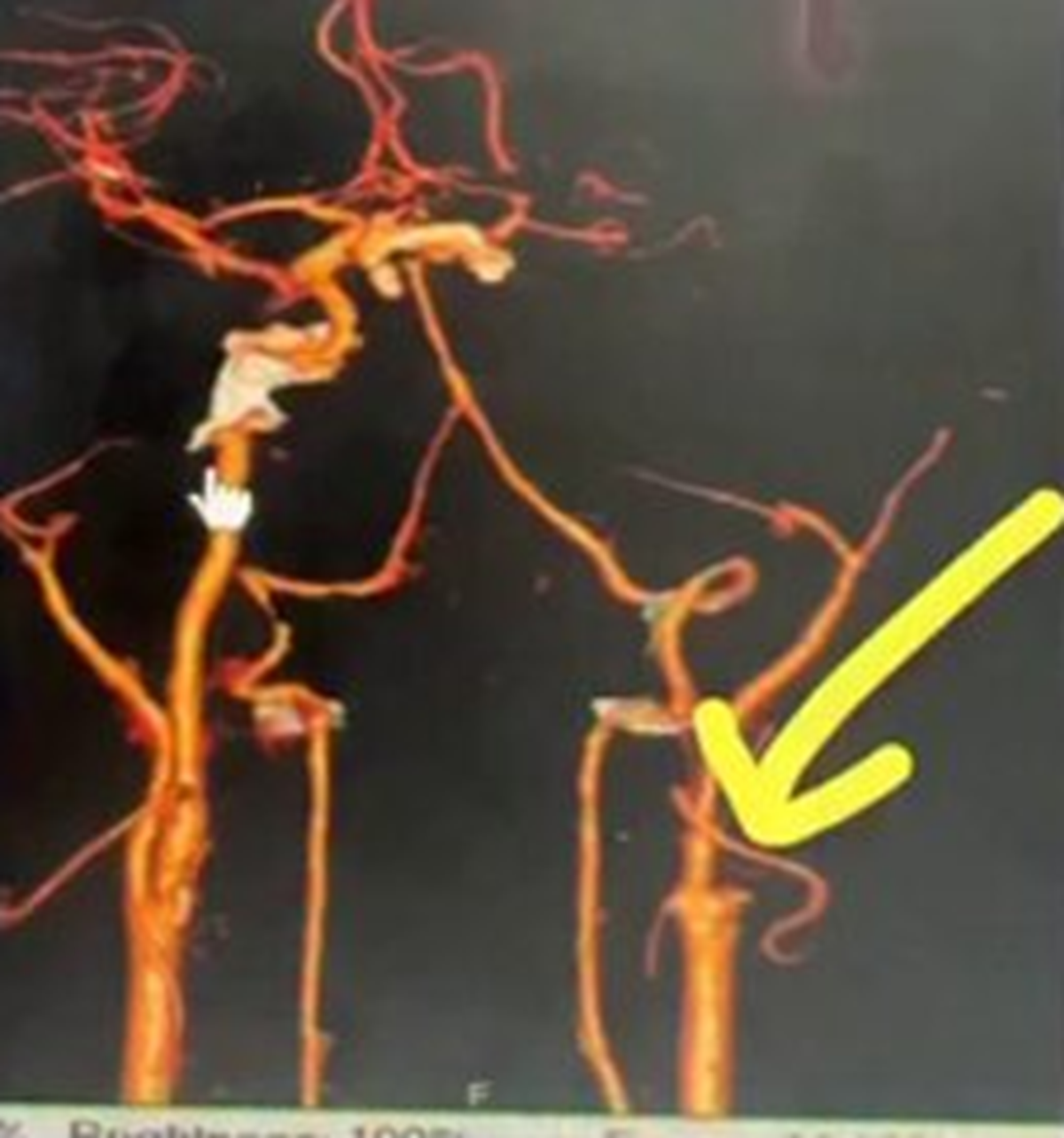 Được vợ mát-xa vì đau cổ, người đàn ông 54 tuổi chết não sau một đêm - Ảnh 2.
